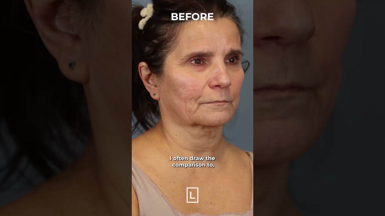 SMAS Facelift video