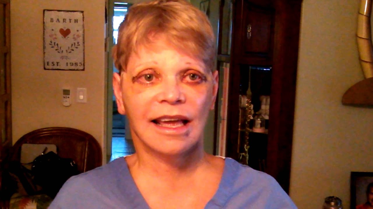 Woman with post-procedure facial appearance and expression.