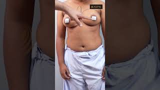 Keyhole FTM top Surgery Marking