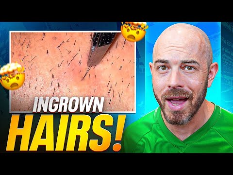 Doctor Reacts to TikTok Ingrown Hairs and more – Safe or Seriously Risky?