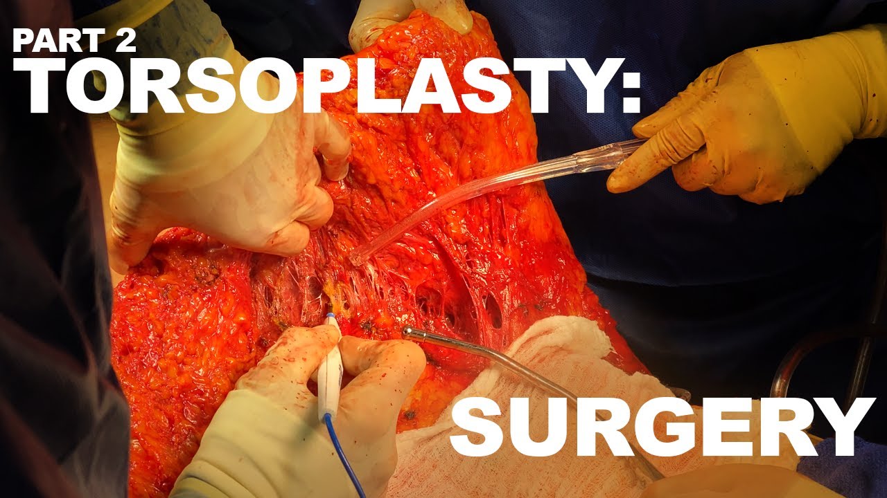 Surgical procedure of torsoplasty in progress.