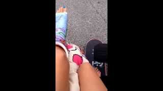 Broken ankle skateboarding.