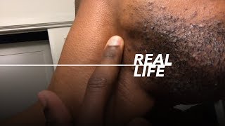 How To Get Rid Of Hair Bumps On Face Videos Kansas City Comic Con
