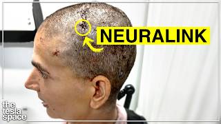 Neuralink Reveals First Female Patient