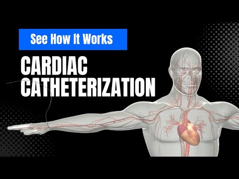 How Cardiac Catheterization Works (3D Animation)