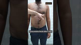 Gynecomastia Result after 4 Years