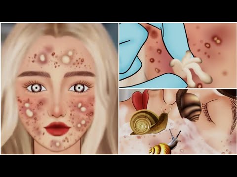 animation 《ASMR》Removing pimples and blackheads from the face