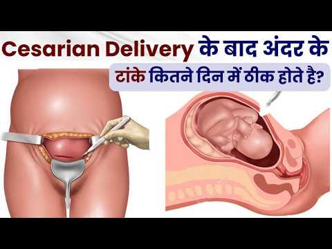 Cesarean Delivery के बाद अंदर के टांके कितने दिन में ठीक होते है | Cesarean Delivery Recovery Time