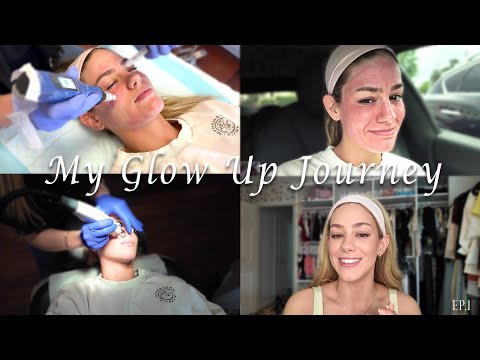 GLOW UP SERIES | Road To The Wedding: I get Microneedling done! | Ep. 1
