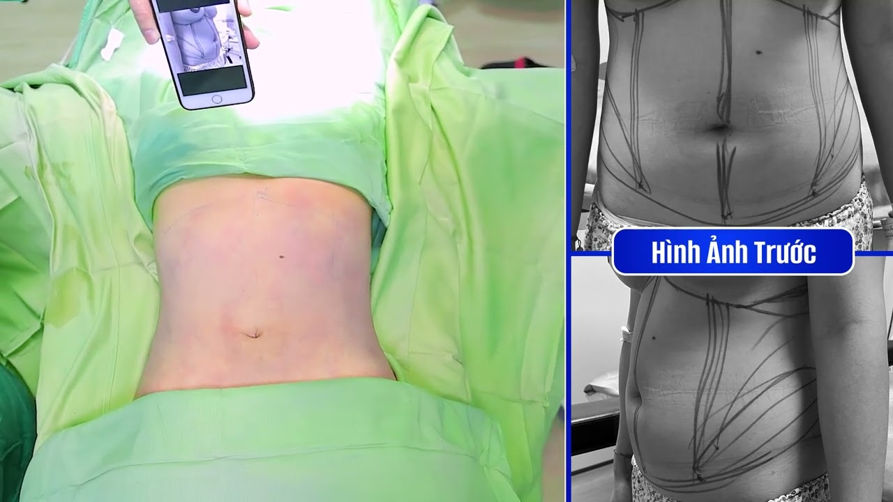 Hút mỡ bụng an toàn "giảm mỡ" hiệu quả: Bụng nhỏ gọn, eo thon, không đau, không sưng