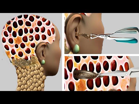 ASMR Animation Treatment | Removal of ticks