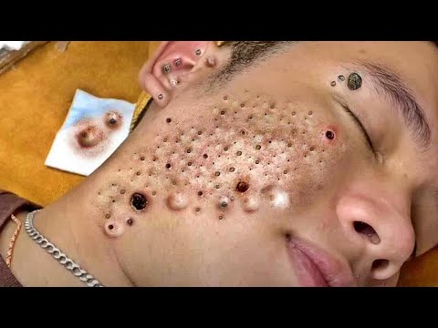 Blackhead Removal With Today Spa #2438