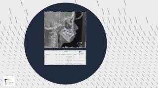 Case khớp cắn hạng II đóng khe thưa hai hàm/ Class II Diastema closure