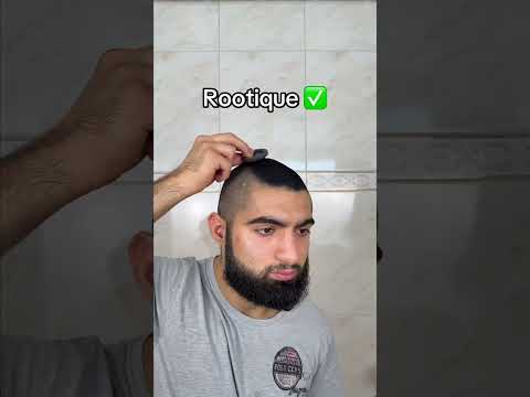 Niewieder Glatze…#glatze #haare #fyp #haarausfall #viral
