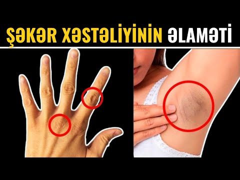 Şəkər Xəstəliyi Necə Başlayır? - 25% İnsan Bu ƏLAMƏTLƏRİ BİLMİR