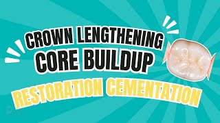 Crown lengthening, core buildup & restoration cementation