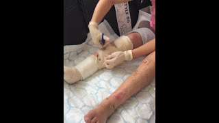 EXTERNAL FIXATOR | Bilateral lower limb fracture | Bandage removal