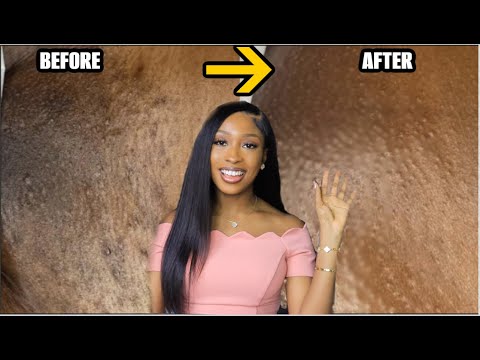 HOW TO GET RID OF DARK SPOTS INGROWN HAIR RAZOR BUMPS HYPERPIGMENTATION FOR GOOD+ LASER HAIR REMOVAL