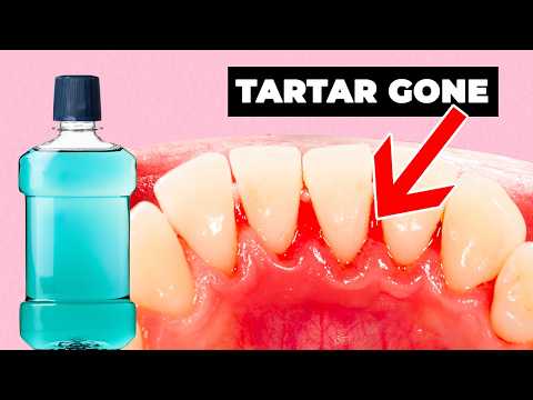 Using Mouthwash To Remove TARTAR Under Your Gums