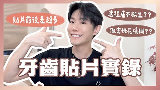做完我後悔了嗎？半年後揭曉牙齒貼片心得｜超完整 G-Smile 鋯白貼片全流程紀錄