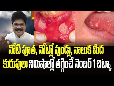నోటి పూత, నోట్లో పుండ్లు, నాలుక మీద కురుపులు నిమిషాల్లో తగ్గించే నెంబర్ 1 చిట్కా! Mouth Ulcer