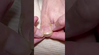 ▶️ Relief starts here Toe Align Ingrown Nail Corrector Stickers ( # 2609 )