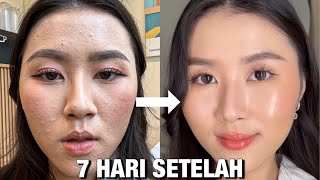 Cara aku Ngatasin BRUNTUSAN dan TEKSTUR KULITKU dalam 7 hari (tanpa perawatan, cuma dirumah)✨