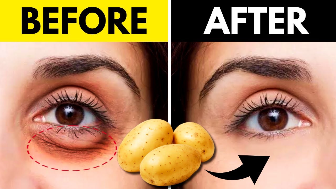 15 Natural Remedies to Get Rid of Under Eye Bags