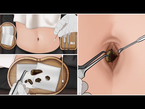 ASMR | Remove Huge Navel Stone Animation