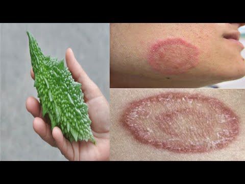 दाद खाज खुजली की 2 दिन में छुट्टी कर देगा | fungal infection treatment at home | dad khaj ka ilaj