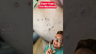 Crazy Huge CHIN BLACKHEAD REMOVAL - Whats Causing This #shorts