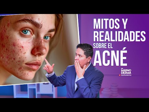 MITOS Y REALIDADES SOBRE EL ACNÉ