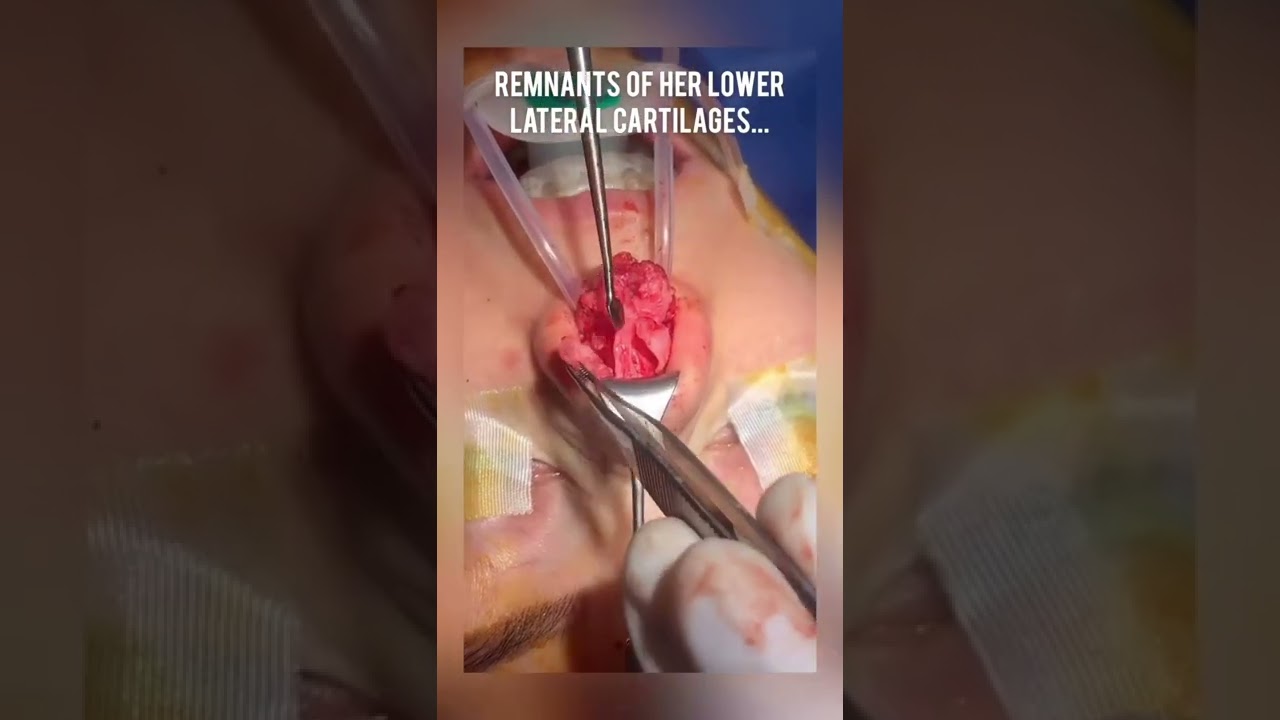 Surgical procedure on lower lateral cartilages.