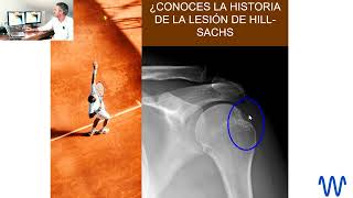 ¿Conoces la historia de hill-sachs?