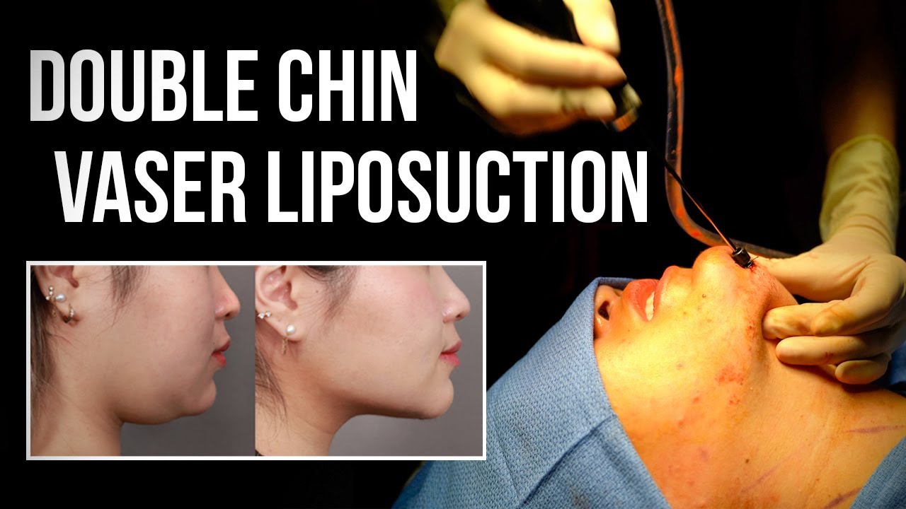 VASER liposuction procedure for double chin reduction