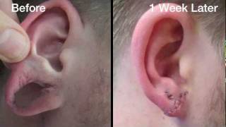 Даже сильная деформация мочки уха может быть легко исправлена