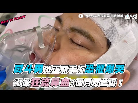 【戽鬥男做正顎手術恐懼爆哭 術後狂流鼻血3個月反差曝】｜Scropy史刮皮日常