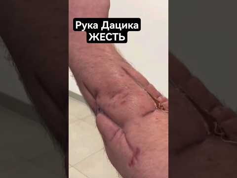 Дацик показал травмированную руку: ЖЕСТЬ #shorts