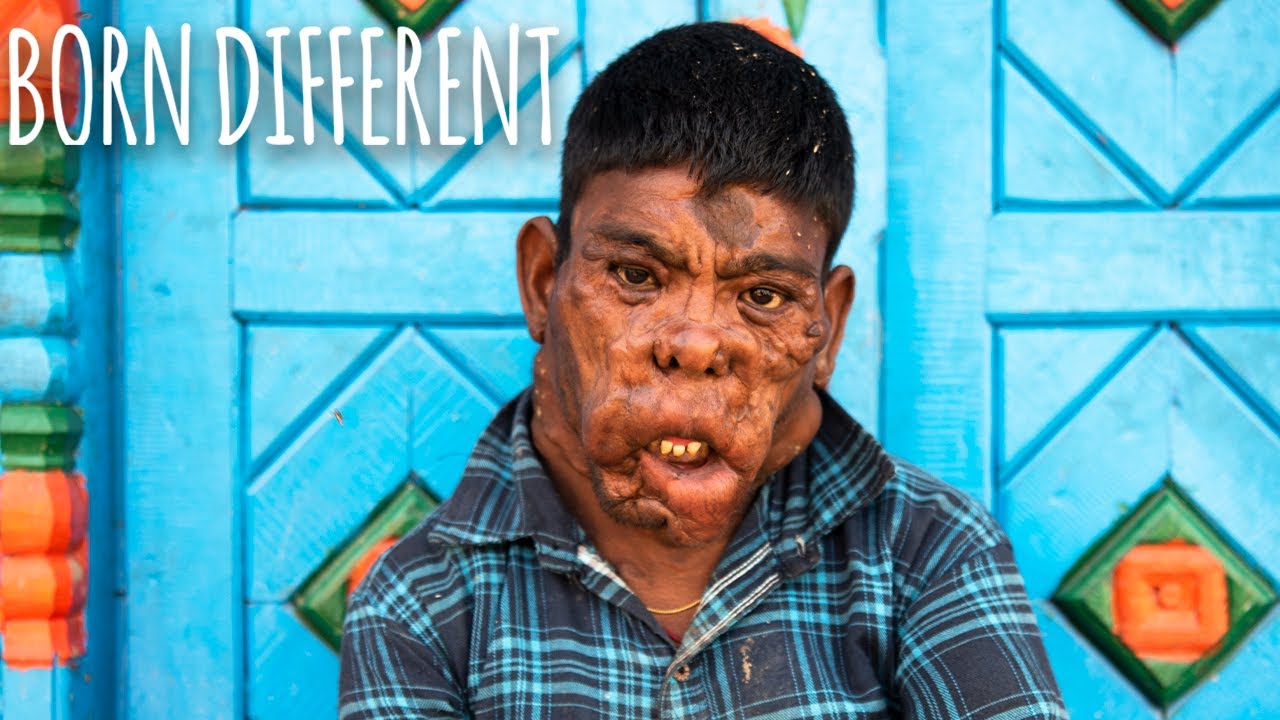 My entire body is covered in tumours - born different