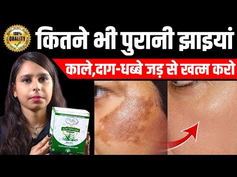 कितने भी मुश्किल झाइयाँ Hyperpigmentation Melasma काले धब्बे Spots हो, इस Remedy से होगा 100% इलाज |