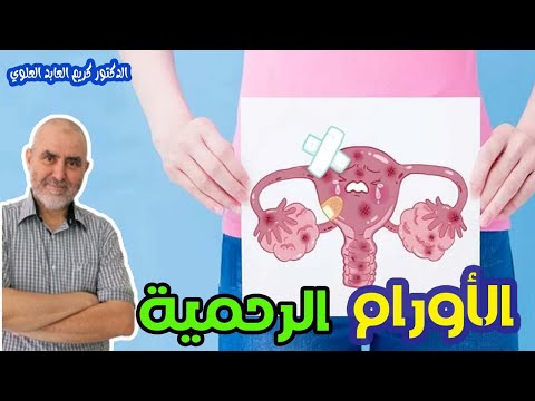 الاورام الليفية الرحمية  -  الدكتور كريم العابد العلوي  -