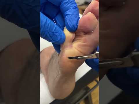 Watch Australian Podiatrist Remove Painful Corn and Callus | Expert Foot Care with Ergonx & Docpods