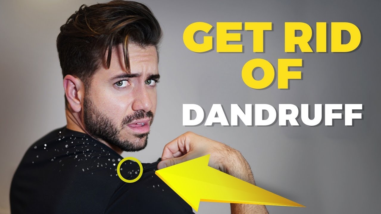 HOW TO GET RID OF DANDRUFF - Men-s Hair - Alex Costa