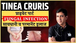 Private Part Fungal Infection का जड़ से इलाज | Tinea Cruris Homeopathy Treatment Explained