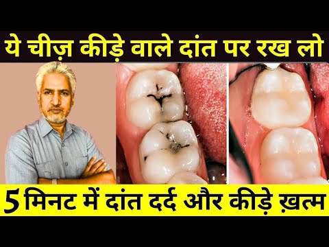 दांतों में कीड़े? जानिए 4 असरदार घरेलू इलाज | |  Teeth Care & Cavity Prevention Tip