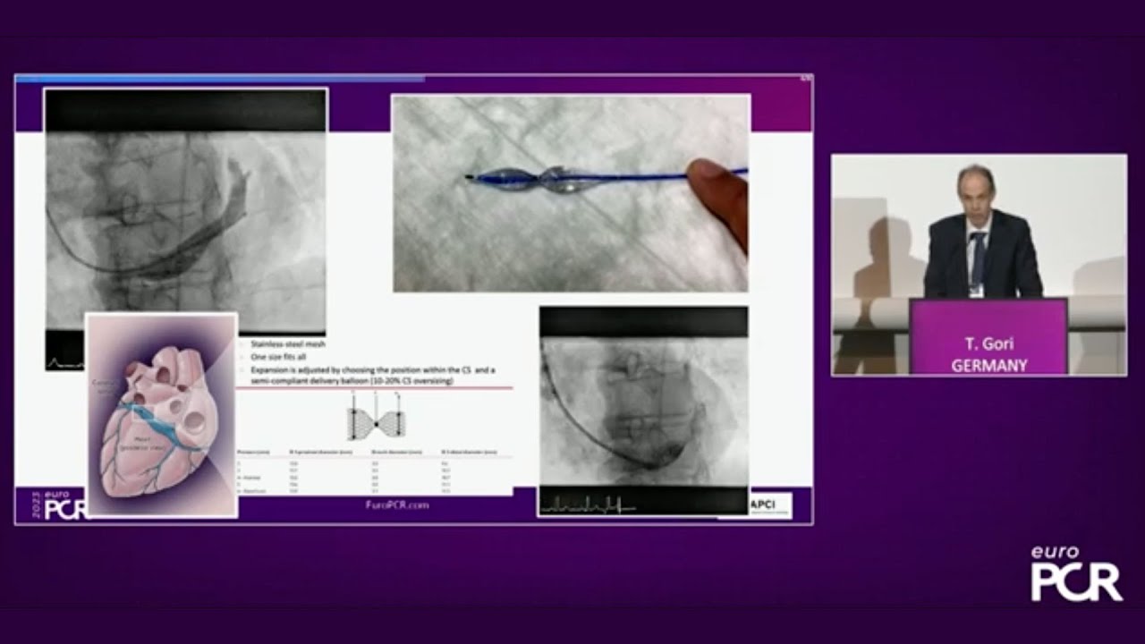 Coronary Sinus Reducer: