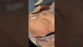 30 dias após a Ju fazer a Mini Abdominoplastia dela!