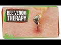 Bee Venom Therapy Insights