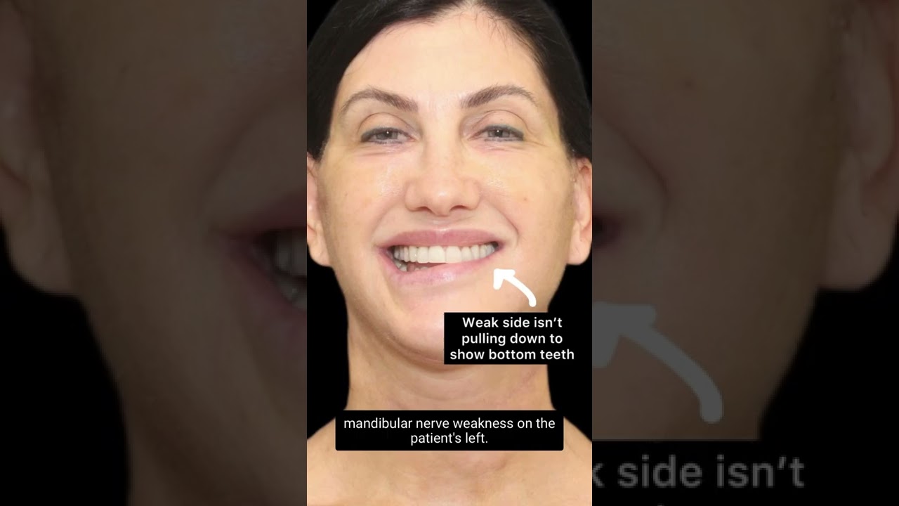 Patient with noticeable facial asymmetry due to weakness.