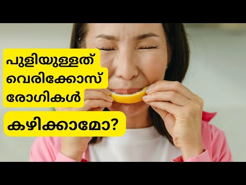 വെരിക്കോസ് വെയിൻ രോഗമുള്ളവർ പുളി യുള്ള ആഹാരം കഴിക്കാമോ?